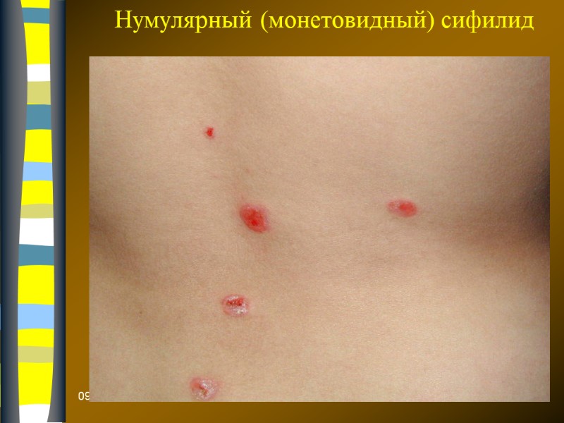 09.12.2017 Нумулярный (монетовидный) сифилид